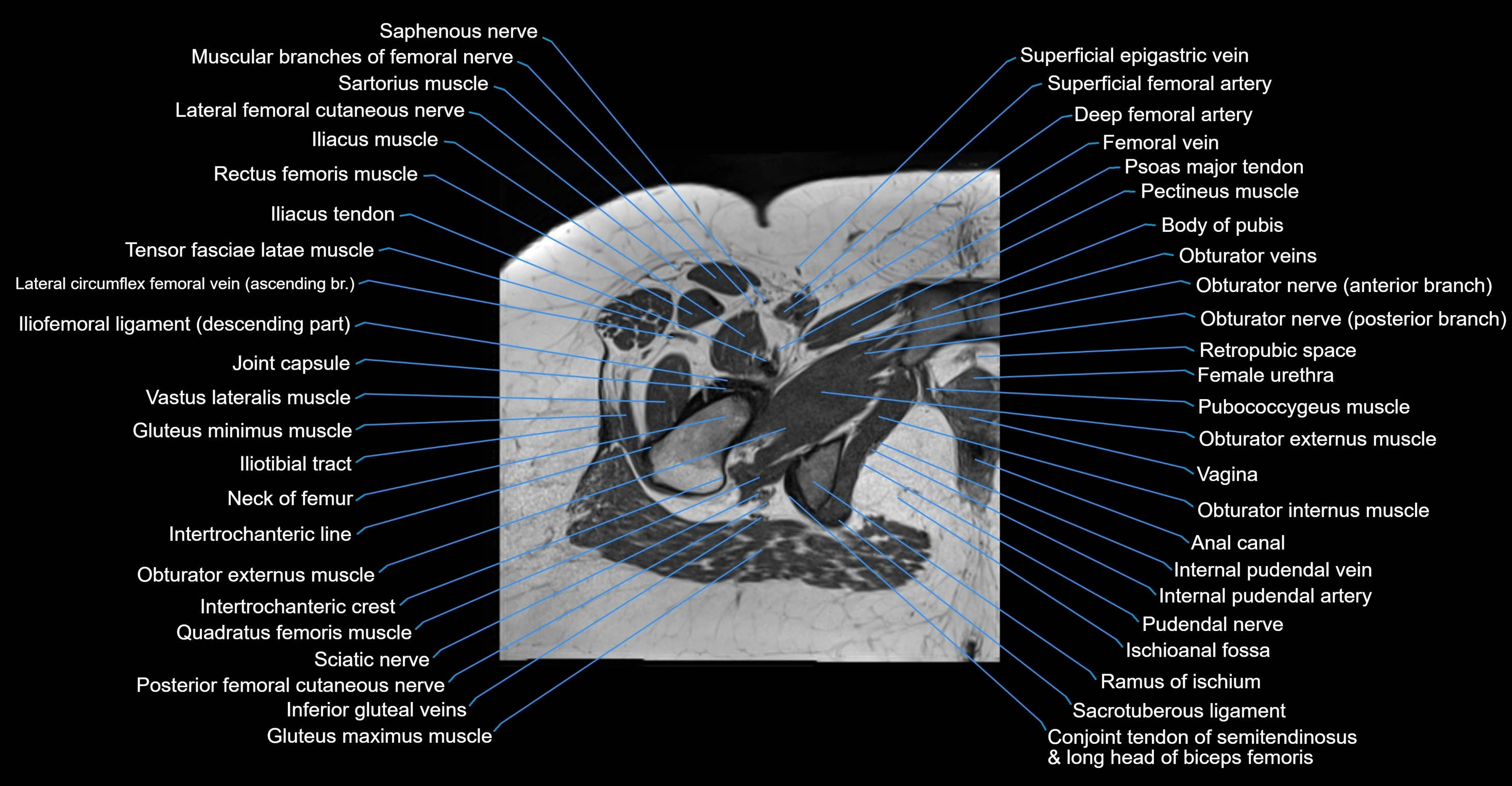 MRI hip axial cross sectional anatomy 3T 3D  radiology  anatomy image-img-00001-00052.webp